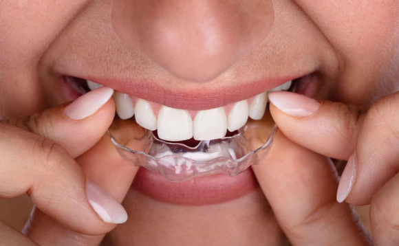 aligner-braces