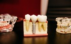 dental-dentist-teeth